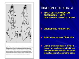 CIRCUMFLEX AORTA
RAA + LEFT LIGAMENTUM
ARTERIOSUM + LEFT
DESCENDING THORACIC AORTA

UNCROSSING OPERATION

Median sternotomy+ CPB+ HCA

Aortic arch mobilized + divided
infront of tracheobronchial tree+
reanastomosed end to side to the
lateral aspect of ascending aorta.

 