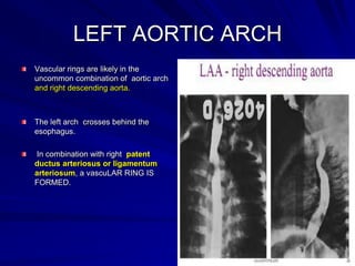 LEFT AORTIC ARCH
Vascular rings are likely in the
uncommon combination of aortic arch
and right descending aorta.

The left arch crosses behind the
esophagus.

In combination with right patent
ductus arteriosus or ligamentum
arteriosum, a vascuLAR RING IS
FORMED.

 