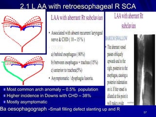 2.1 L AA with retroesophageal R SCA

Most common arch anomaly – 0.5% population
Higher incidence in Downs with CHD – 38%
Mostly asymptomatic

Ba oesophagograph -Small filling defect slanting up and R

57

 