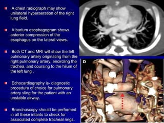 A chest radiograph may show
unilateral hyperaeration of the right
lung field.
A barium esophagogram shows
anterior compression of the
esophagus on the lateral views.
Both CT and MRI will show the left
pulmonary artery originating from the
right pulmonary artery, encircling the
trachea, and coursing to the hilum of
the left lung .
Echocardiography is- diagnostic
procedure of choice for pulmonary
artery sling for the patient with an
unstable airway.
Bronchoscopy should be performed
in all these infants to check for
associated complete tracheal rings.

 