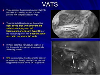 VATS
Video-assisted thoracoscopic surgery (VATS)
has been successfully applied to some
patients with complete vascular rings.

The most suitable patients are those with a

right aortic arch with aberrant left
subclavian artery and left
ligamentum arteriosum (type IB) and
the occasional patient with a double aortic
arch with an atretic left arch.

In these patients a nonvascular segment of
the ring can be approached endoscopically
and safely divided.

MRI can accurately detect segmental patency
or atresia and thereby identify those vascular
ring patients suitable for the VATS approach.

 