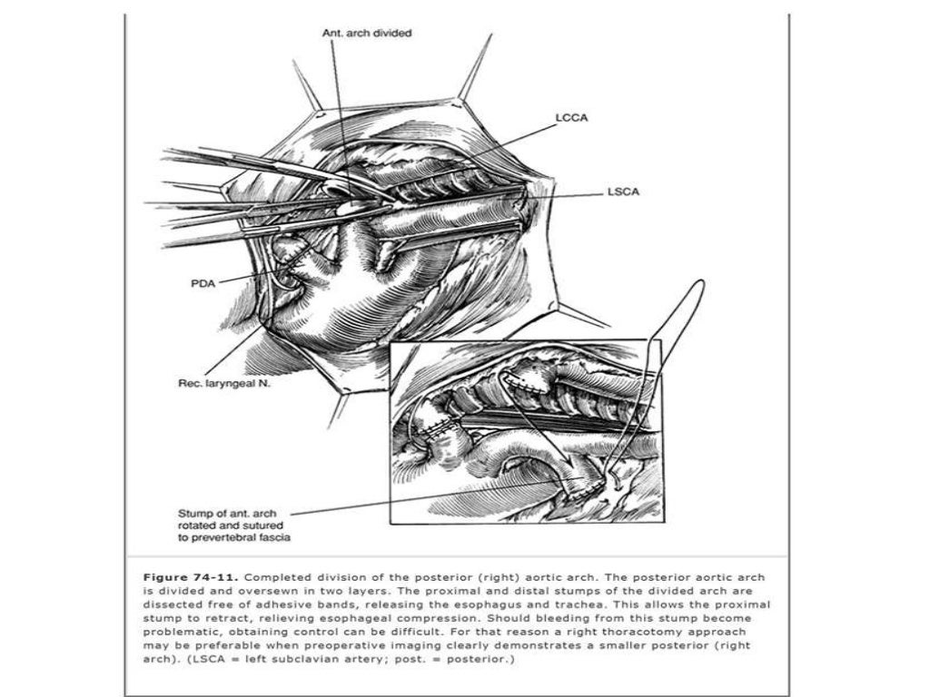 Vascular ring and sling