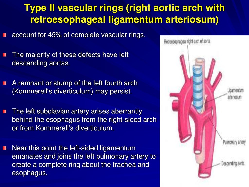 Vascular ring and sling