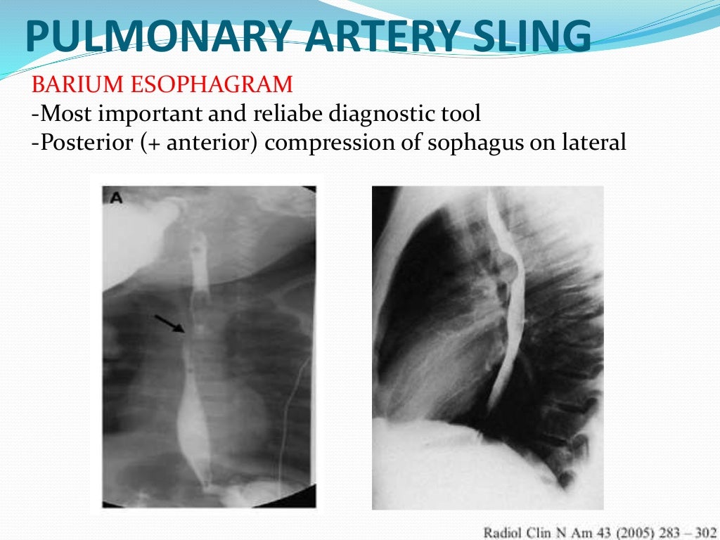Vascular ring & Sling