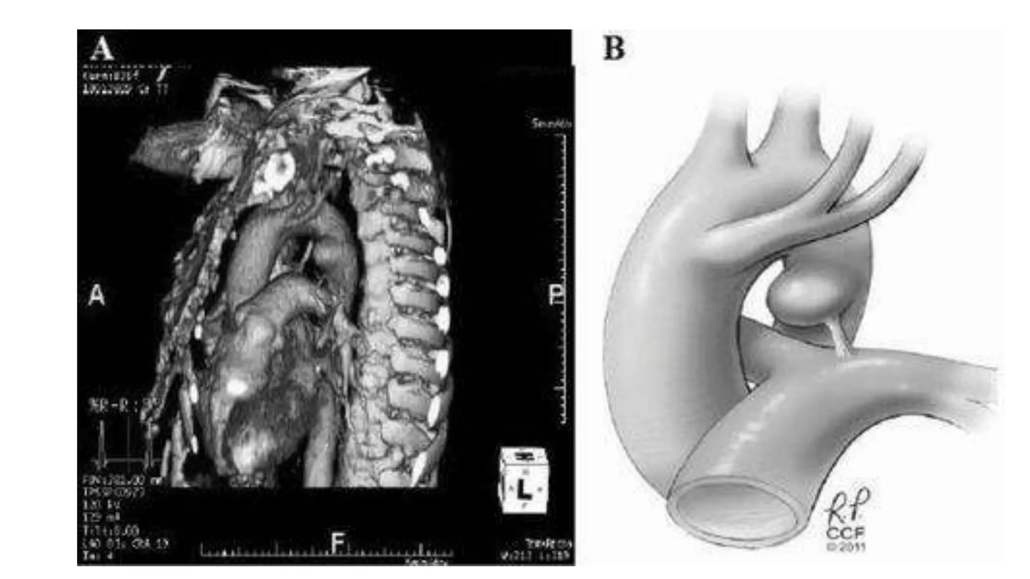 VASCULAR RINGS AND SLINGS TYPES HAEMODYNAMICS PRESENTATION AND ...