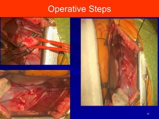 Operative Steps
11
 