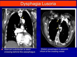 Aberrant subclavian is seen
crossing behind the oesophagus
Dilated oesophagus is apparent
infront of the crossing vessel
Dysphagia Lusoria
 
