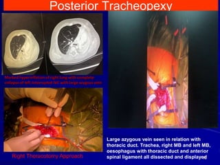 Posterior Tracheopexy
Marked hyperinflation of right lung with complete
collapse of left.Interrupted IVC with large azygous vein
Large azygous vein seen in relation with
thoracic duct. Trachea, right MB and left MB,
oesophagus with thoracic duct and anterior
spinal ligament all dissected and displayed16Right Thoracotomy Approach
 