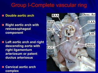 Group I-Complete vascular ring
Double aortic arch
Right aortic arch with
retroesophageal
component
Left aortic arch and right
descending aorta with
right ligamentum
arteriosum or patent
ductus arteriosus
Cervical aortic arch
complex
 