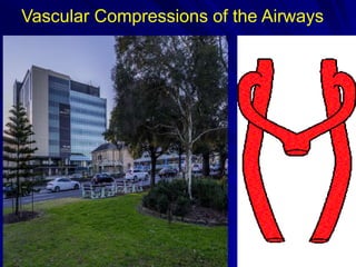 Vascular Compressions of the Airways
 