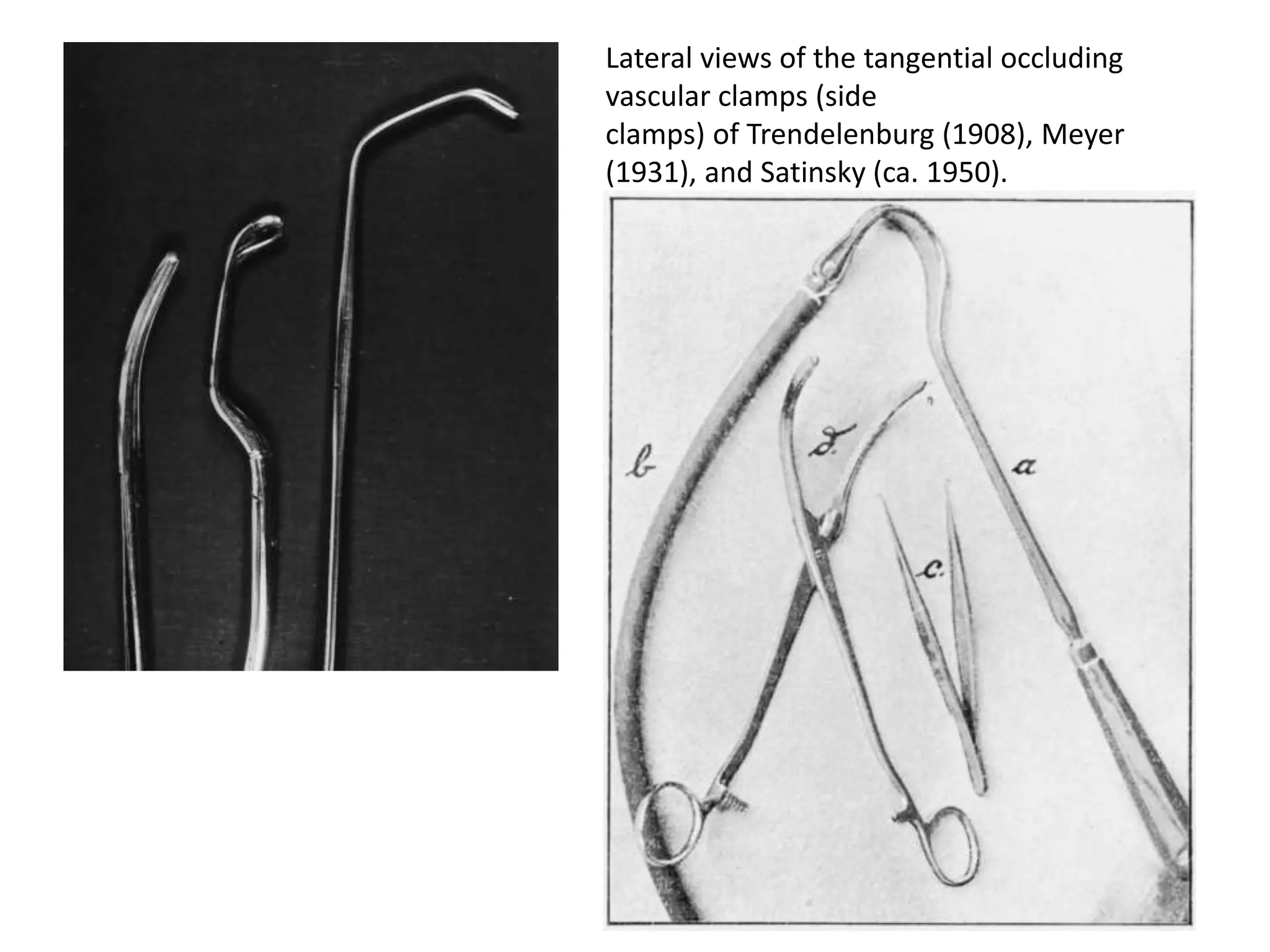 Lateral views of the tangential occluding
vascular clamps (side
clamps) of Trendelenburg (1908), Meyer
(1931), and Satinsky (ca. 1950).
 