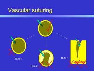 Rule 1
Rule 2
Rule 3
Vascular suturing
 
