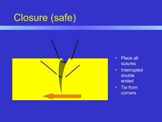 Closure (safe)
• Place all
sutures
• Interrupted
double
ended
• Tie from
corners
 