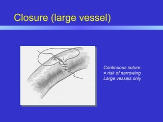 Closure (large vessel)
Continuous suture
= risk of narrowing
Large vessels only
 