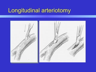 Longitudinal arteriotomy
 