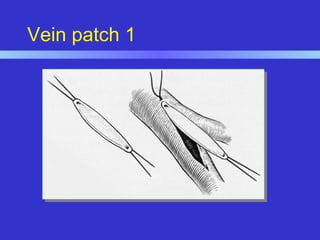 Vein patch 1
 