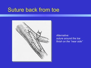Suture back from toe
Alternative:
suture around the toe
finish on the “near side”
 