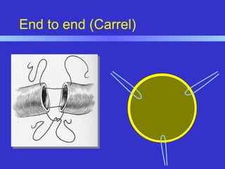 End to end (Carrel)
 