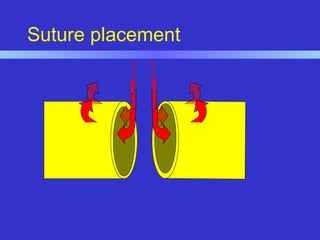 Suture placement
 