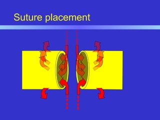 Suture placement
 