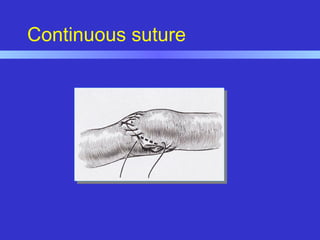 Continuous suture
 