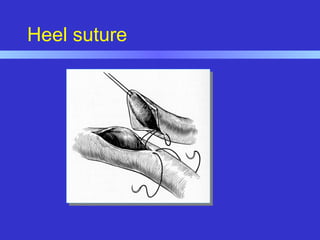 Heel suture
 