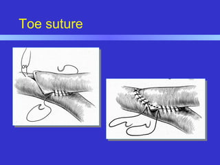 Toe suture
 