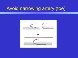 Avoid narrowing artery (toe)
 