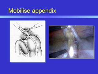 Mobilise appendix
 
