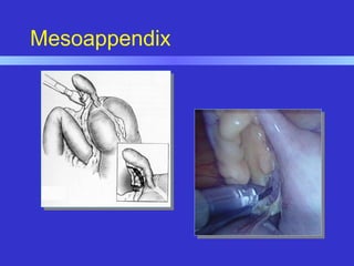 Mesoappendix
 
