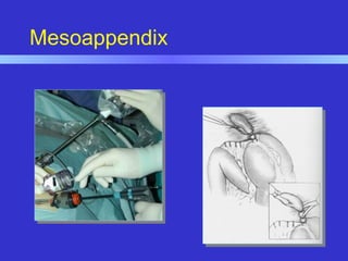 Mesoappendix
 