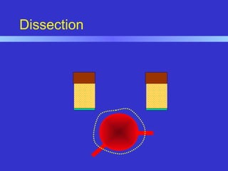 Dissection
 