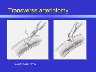 Transverse arteriotomy
Hold vessel firmly
 