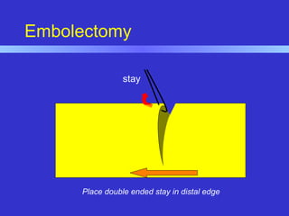 Embolectomy
stay
Place double ended stay in distal edge
 