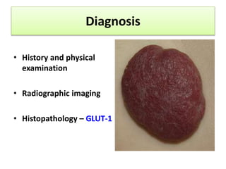 History 
• The diagnosis is typically made clinically based on 
its appearance and characteristic behavior 
• Between 30% ...