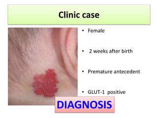 Clinic case 
• Female 
• 2 weeks after birth 
• Premature antecedent 
• GLUT-1 positive 
DIAGNOSIS 
 