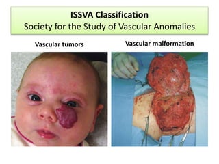 Vascular anomalies 
Vascular Tumors Vascular malformaciones 
Infantile 
hemangioma 
Congenital 
hemangioma 
NICH RICH 
• C...
