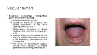 Vascular tumors
• Hereditary hemorrhagic telangiectasia
(Osler-Weber-Rendu disease)
• Autosomal dominant disorder
• Caused by mutations in genes that
encode components of the TGF-ß
signaling pathway in ECs
• Malformations composed of dilated
capillaries and veins that are present at
birth
• They are widely distributed over the skin
and oral mucous membranes, as well as
in the respiratory, gastrointestinal, and
urinary tracts
• The lesions can spontaneously rupture,
causing serious epistaxis (nosebleed),
gastrointestinal bleeding, or hematuria.
 