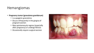 Hemangiomas
• Pregnancy tumor (granuloma gravidarum)
• Is a pyogenic granuloma
• Occurs infrequently in the gingiva of
pregnant women
• May spontaneously regress (especially
after pregnancy) or undergo fibrosis
• Occasionally require surgical excision
 