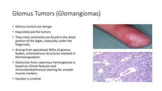 Glomus Tumors (Glomangiomas)
• Glomus tumors are benign
• Exquisitely painful tumors
• They most commonly are found in the distal
portion of the digits, especially under the
fingernails.
• Arising from specialized SMCs of glomus
bodies, arteriovenous structures involved in
thermoregulation.
• Distinction from cavernous hemangiomas is
based on clinical features and
immunohistochemical staining for smooth
muscle markers.
• Excision is curative
 