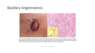 Bacillary Angiomatosis
 