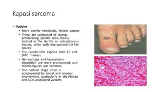Kaposi sarcoma
• Nodules
• More overtly neoplastic, lesions appear
• These are composed of plump,
proliferating spindle cells, mostly
located in the dermis or subcutaneous
tissues, often with interspersed slit like
spaces
• The spindle cells express both EC and
SMC markers
• Hemorrhage and hemosiderin
deposition are more pronounced, and
mitotic figures are common
• The nodular stage often is
accompanied by nodal and visceral
involvement, particularly in the African
and AIDS-associated variants
 