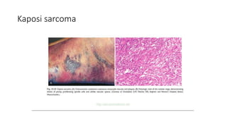 Kaposi sarcoma
 