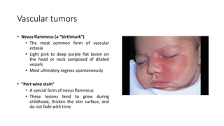 Vascular tumors
• Nevus flammeus (a “birthmark”)
• The most common form of vascular
ectasia
• Light pink to deep purple flat lesion on
the head or neck composed of dilated
vessels
• Most ultimately regress spontaneously
• “Port wine stain”
• A special form of nevus flammeus
• These lesions tend to grow during
childhood, thicken the skin surface, and
do not fade with time
 