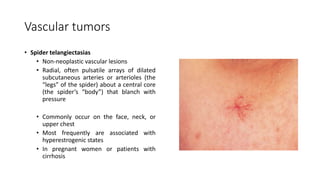 Vascular tumors
• Spider telangiectasias
• Non-neoplastic vascular lesions
• Radial, often pulsatile arrays of dilated
subcutaneous arteries or arterioles (the
“legs” of the spider) about a central core
(the spider’s “body”) that blanch with
pressure
• Commonly occur on the face, neck, or
upper chest
• Most frequently are associated with
hyperestrogenic states
• In pregnant women or patients with
cirrhosis
 