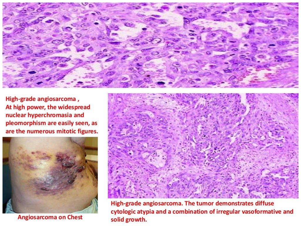 Vascular tumors 8