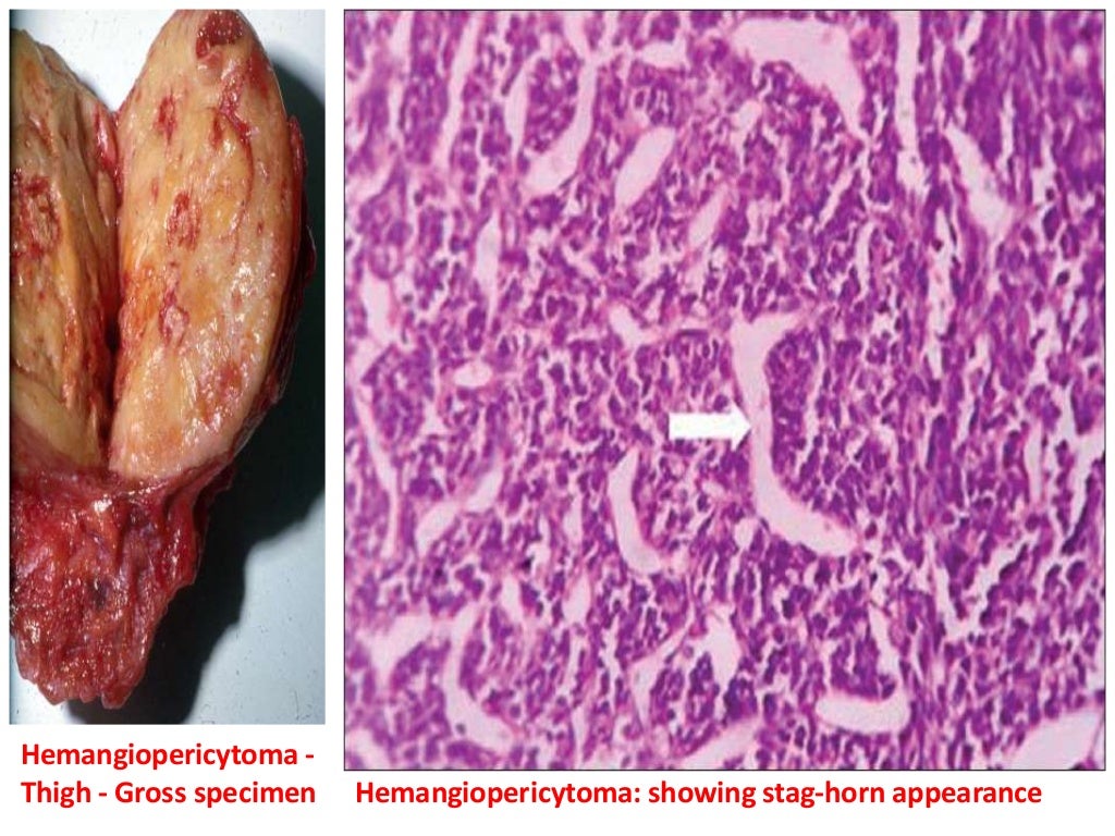 Vascular tumors 8