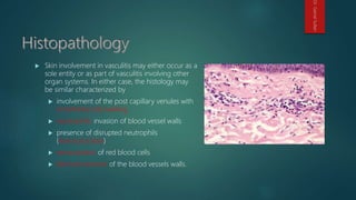 Skin involvement in vasculitis may either occur as a
sole entity or as part of vasculitis involving other
organ systems. In either case, the histology may
be similar characterized by
 involvement of the post capillary venules with
endothelial cell swelling
 neutrophilic invasion of blood vessel walls
 presence of disrupted neutrophils
(leukocytoclasia)
 extravasation of red blood cells
 fibrinoid necrosis of the blood vessels walls.
Dr.GamalSultan
 