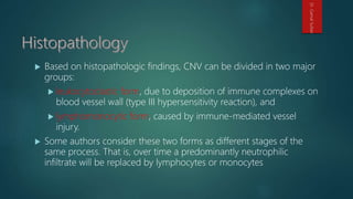  Based on histopathologic findings, CNV can be divided in two major
groups:
 leukocytoclastic form, due to deposition of immune complexes on
blood vessel wall (type III hypersensitivity reaction), and
 lymphomonocytic form, caused by immune-mediated vessel
injury.
 Some authors consider these two forms as different stages of the
same process. That is, over time a predominantly neutrophilic
infiltrate will be replaced by lymphocytes or monocytes
Dr.GamalSultan
 