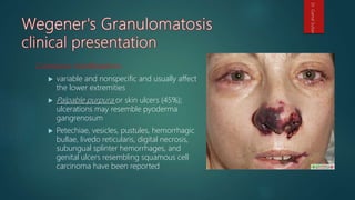 Cutaneous manifestations
 variable and nonspecific and usually affect
the lower extremities
 Palpable purpura or skin ulcers (45%);
ulcerations may resemble pyoderma
gangrenosum
 Petechiae, vesicles, pustules, hemorrhagic
bullae, livedo reticularis, digital necrosis,
subungual splinter hemorrhages, and
genital ulcers resembling squamous cell
carcinoma have been reported
Dr.GamalSultan
 